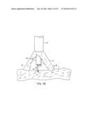 Complex Shape Steerable Tissue Visualization and Manipulation Catheter diagram and image