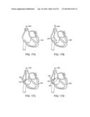 Complex Shape Steerable Tissue Visualization and Manipulation Catheter diagram and image