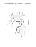 LYMPHEDEMA MEDICAL DEVICE diagram and image