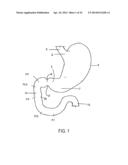 METHODS AND DEVICES TO CURB APPETITE AND/OR TO REDUCE FOOD INTAKE diagram and image