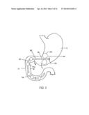 METHODS AND DEVICES TO CURB APPETITE AND/OR TO REDUCE FOOD INTAKE diagram and image