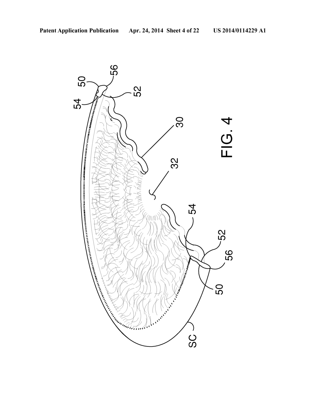 OCULAR IMPLANTS FOR DELIVERY INTO THE EYE - diagram, schematic, and image 05