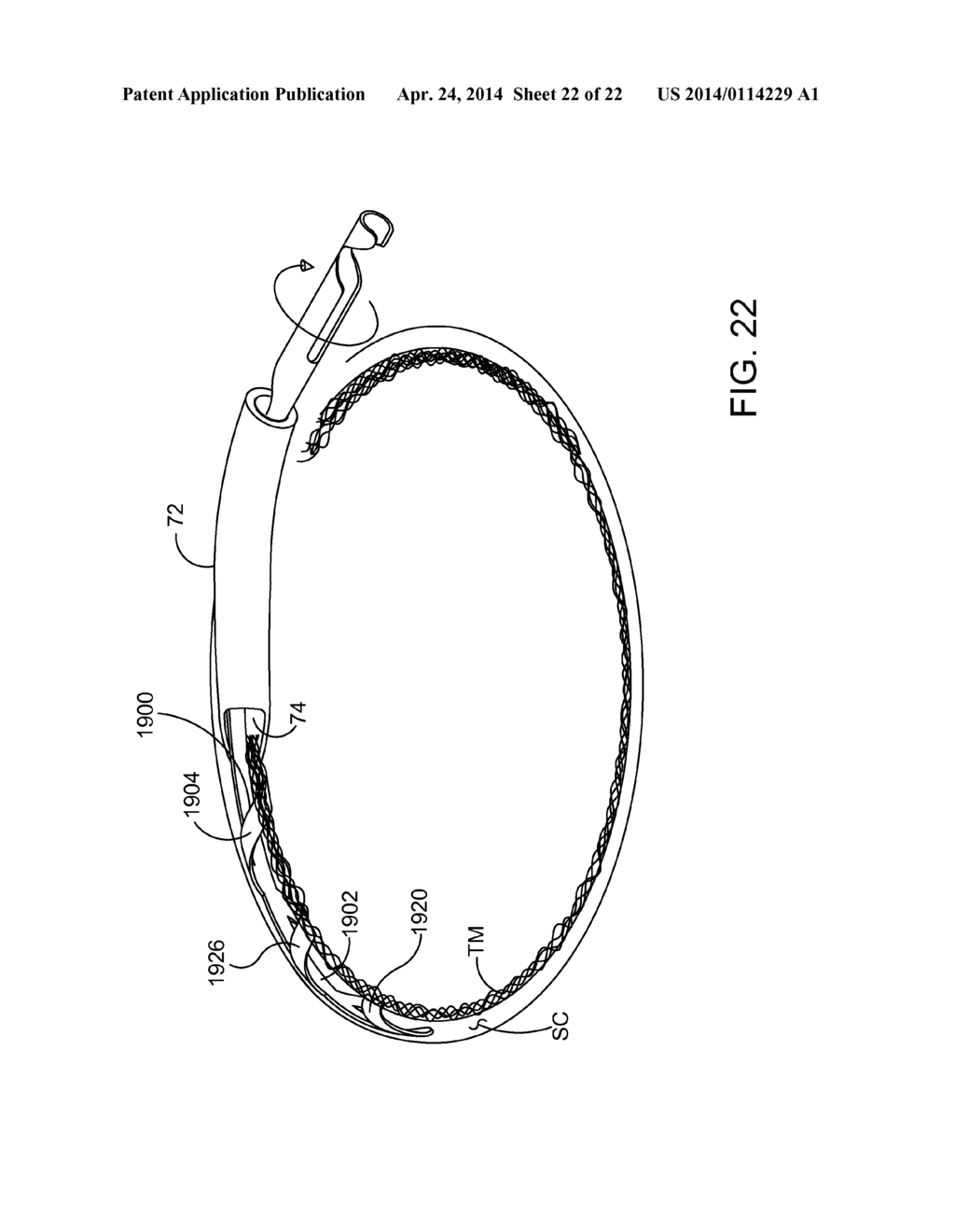 OCULAR IMPLANTS FOR DELIVERY INTO THE EYE - diagram, schematic, and image 23