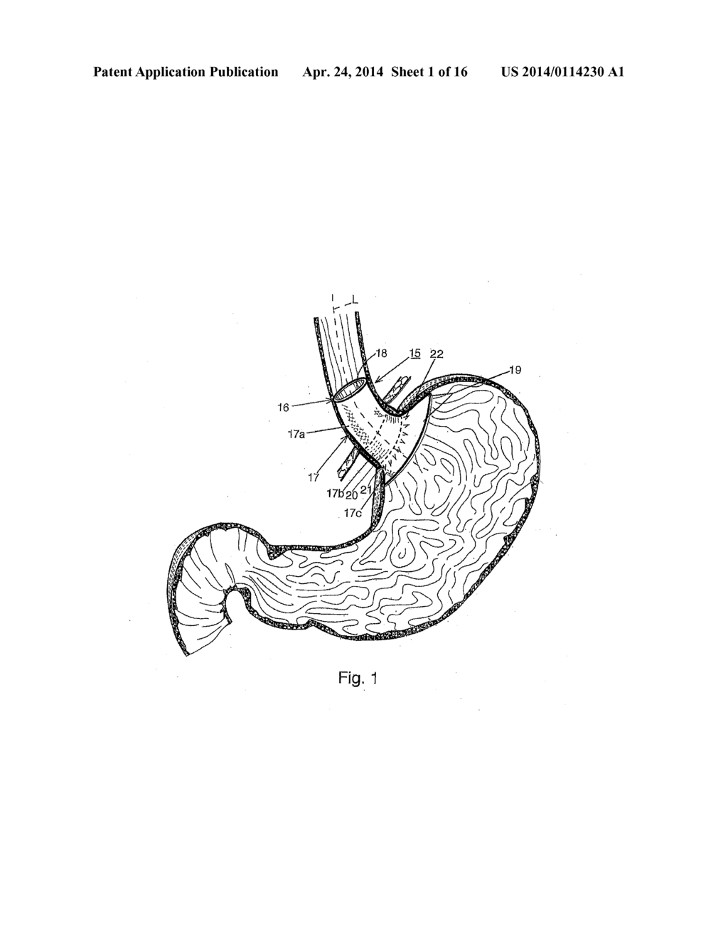 BARIATRIC DEVICE AND METHOD - diagram, schematic, and image 02