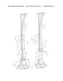 INTRAMEDULLARY IMPLANTS FOR REPLACING LOST BONE diagram and image