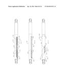 INTRAMEDULLARY IMPLANTS FOR REPLACING LOST BONE diagram and image