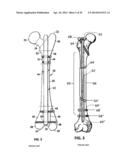 Flexible Intramedullary Nail diagram and image