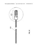 Flexible Intramedullary Nail diagram and image