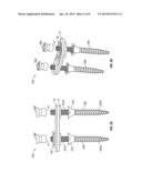 Posterior Lumbar Plate diagram and image