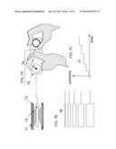 TREATMENT OF AN OCCLUSION OF A BLOOD VESSEL diagram and image