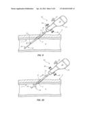 DISTAL BALLOON BOND FOR TEMPORARY SEALING LOCATION DEVICE AND METHODS diagram and image