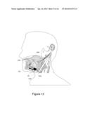 Electrode Configuration for Implantable Modulator diagram and image