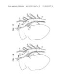 VAGUS NERVE STIMULATION diagram and image