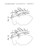 VAGUS NERVE STIMULATION diagram and image