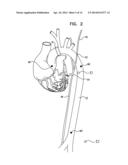 VAGUS NERVE STIMULATION diagram and image