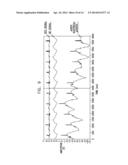 VAGUS NERVE STIMULATION diagram and image