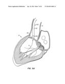 LOW PROFILE HEART VALVE AND DELIVERY SYSTEM diagram and image