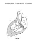 LOW PROFILE HEART VALVE AND DELIVERY SYSTEM diagram and image