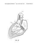 LOW PROFILE HEART VALVE AND DELIVERY SYSTEM diagram and image