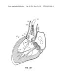 LOW PROFILE HEART VALVE AND DELIVERY SYSTEM diagram and image