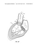 LOW PROFILE HEART VALVE AND DELIVERY SYSTEM diagram and image