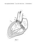 LOW PROFILE HEART VALVE AND DELIVERY SYSTEM diagram and image