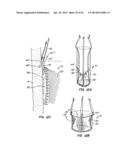 LOW PROFILE HEART VALVE AND DELIVERY SYSTEM diagram and image