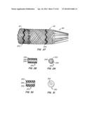 LOW PROFILE HEART VALVE AND DELIVERY SYSTEM diagram and image