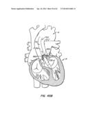 LOW PROFILE HEART VALVE AND DELIVERY SYSTEM diagram and image