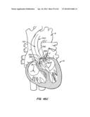 LOW PROFILE HEART VALVE AND DELIVERY SYSTEM diagram and image