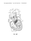 LOW PROFILE HEART VALVE AND DELIVERY SYSTEM diagram and image