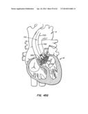 LOW PROFILE HEART VALVE AND DELIVERY SYSTEM diagram and image