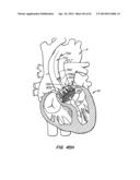 LOW PROFILE HEART VALVE AND DELIVERY SYSTEM diagram and image