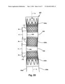 INTRALUMINAL DEVICE AND METHOD WITH ENHANCED ANTI-MIGRATION diagram and image