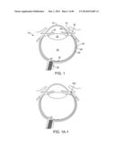 IMPLANTABLE THERAPEUTIC DEVICE diagram and image