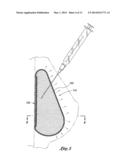 INFLATABLE PROSTHESES AND METHODS OF MAKING SAME diagram and image