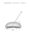 INFLATABLE PROSTHESES AND METHODS OF MAKING SAME diagram and image