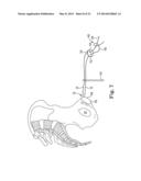 MALE INCONTINENCE TREATMENT SYSTEM diagram and image