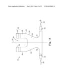 MALE INCONTINENCE TREATMENT SYSTEM diagram and image