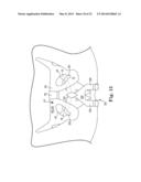 MALE INCONTINENCE TREATMENT SYSTEM diagram and image