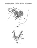 ADJUSTABLE TENSION INCONTINENCE SLING ASSEMBLIES diagram and image