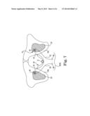 INCONTINENCE TREATMENT DEVICE INCLUDING NON-POROUS SUB-URETHRAL SLING diagram and image