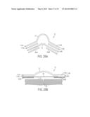 Force Modulating Tissue Bridge diagram and image