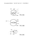 DEPLOYMENT MECHANISM FOR BODY VESSEL INSERTION DEVICES diagram and image