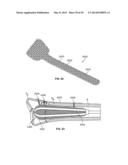 APPARATUS AND METHODS FOR FRACTURE REPAIR diagram and image