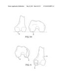 UNICOMPARTMENTAL CUSTOMIZED ARTHROPLASTY CUTTING JIGS diagram and image