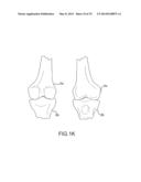 UNICOMPARTMENTAL CUSTOMIZED ARTHROPLASTY CUTTING JIGS diagram and image