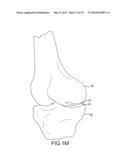 UNICOMPARTMENTAL CUSTOMIZED ARTHROPLASTY CUTTING JIGS diagram and image