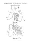 UNICOMPARTMENTAL CUSTOMIZED ARTHROPLASTY CUTTING JIGS diagram and image