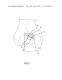 UNICOMPARTMENTAL CUSTOMIZED ARTHROPLASTY CUTTING JIGS diagram and image